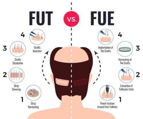 fue植发能保持多久？延长FUE植发效果的方法