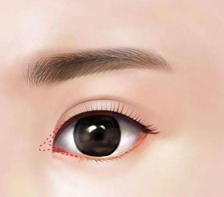 疤痕体质可以做双眼皮手术吗?