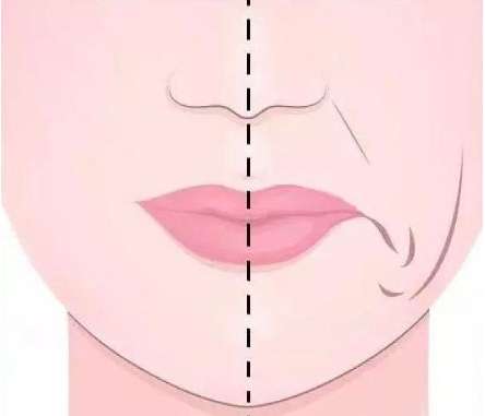 填充鼻唇沟应该用什么玻尿酸
