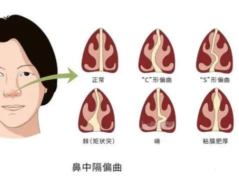 影响鼻中隔偏曲价格的因素有哪些